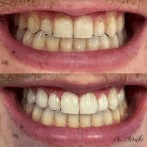 Before After treatment - Whitby Dental Office