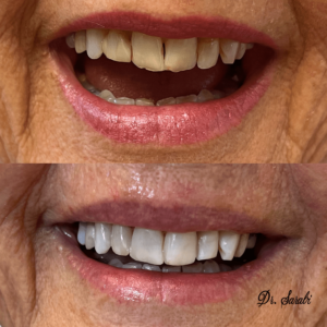Before After treatment - Whitby Dental Office