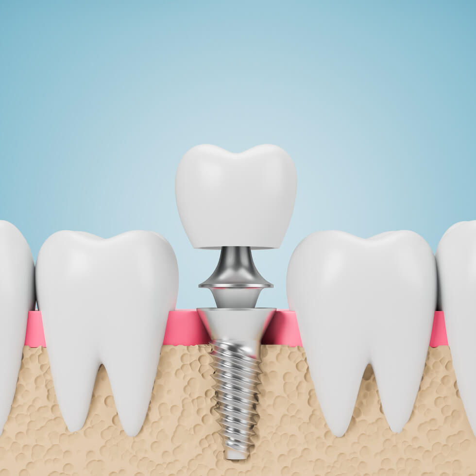 dental implants Whitby