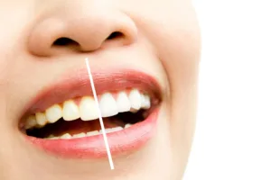 Renew Your Smile with Teeth Whitening in Whitby
