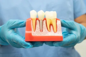 Whitby s Dental Restoration Options
