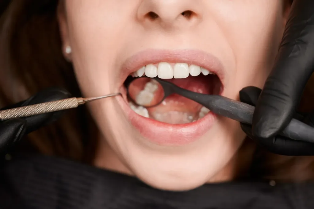 Deep Pockets Between Teeth and Gums