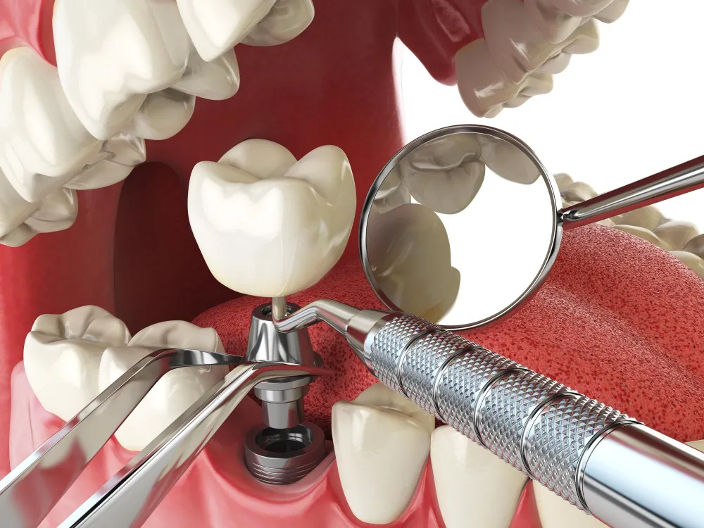 dental implants in whitby