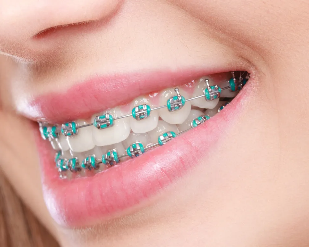 low cost teeth braces