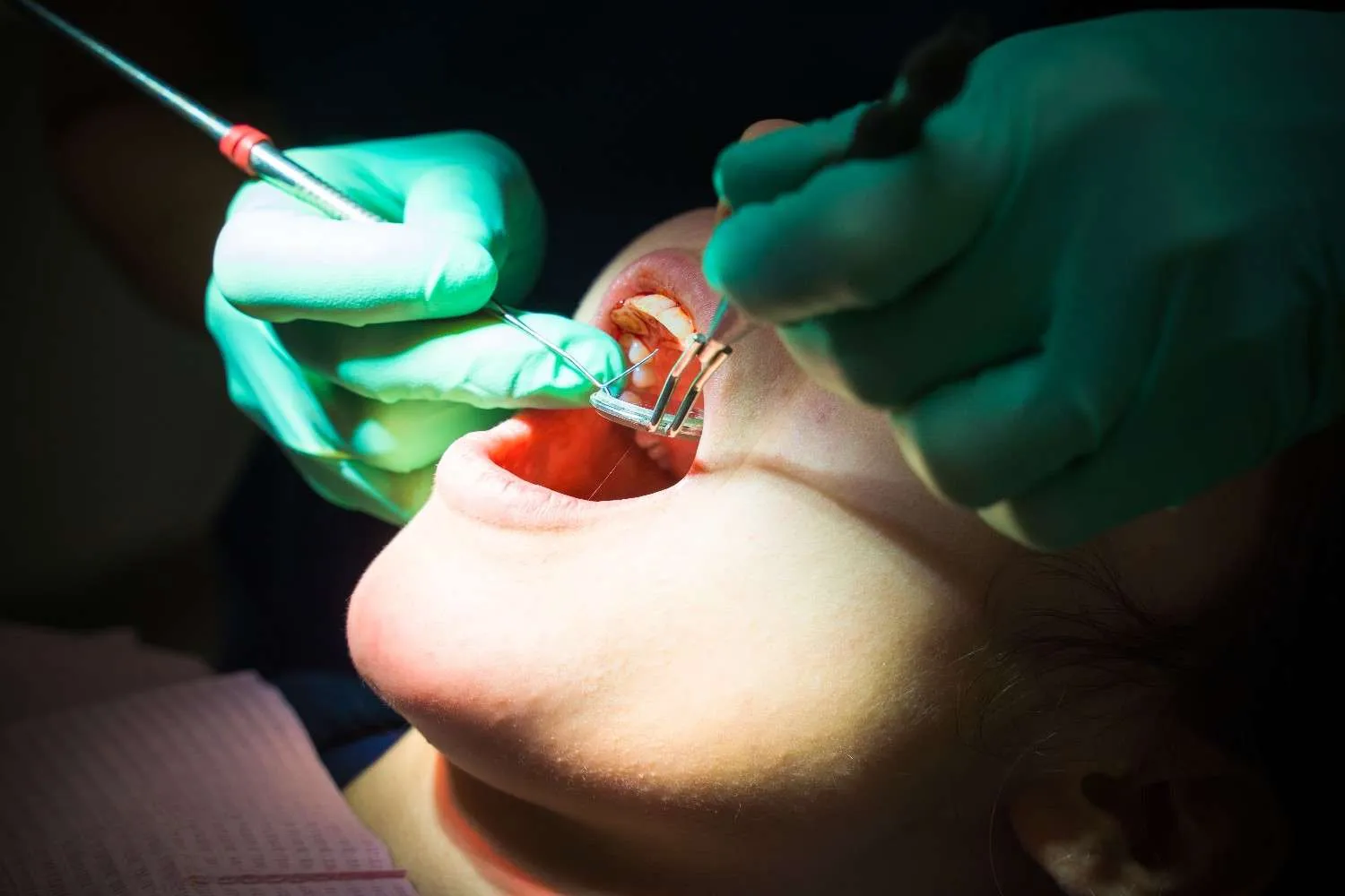 splinting periodontal