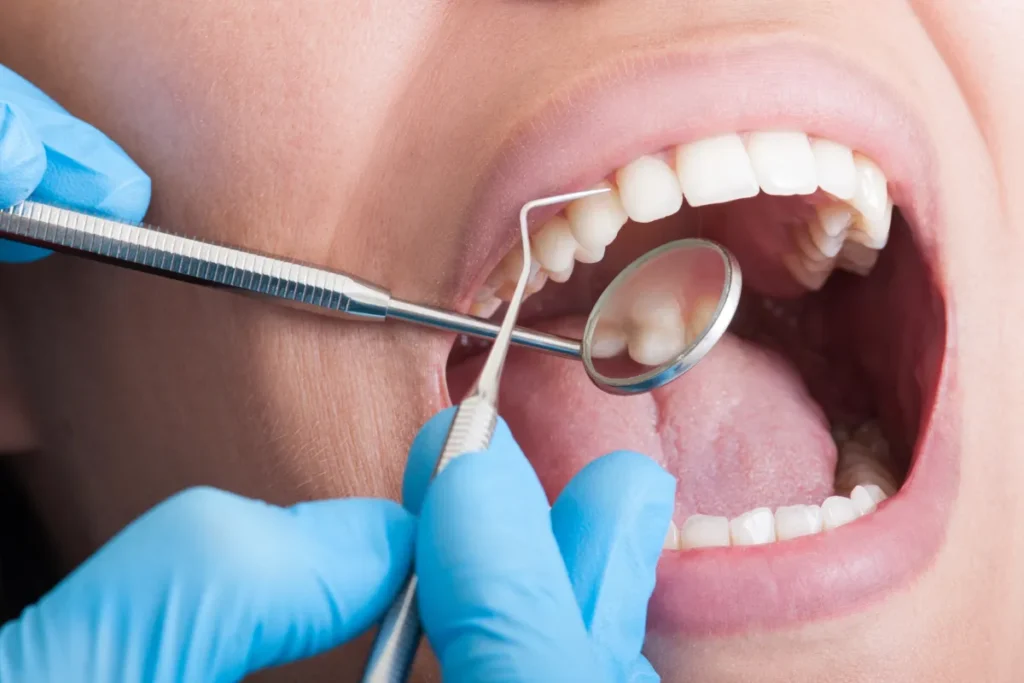 Removal of Plaque and Tartar