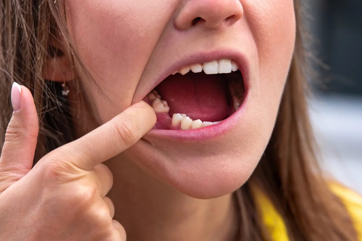 What is Gum Disease
