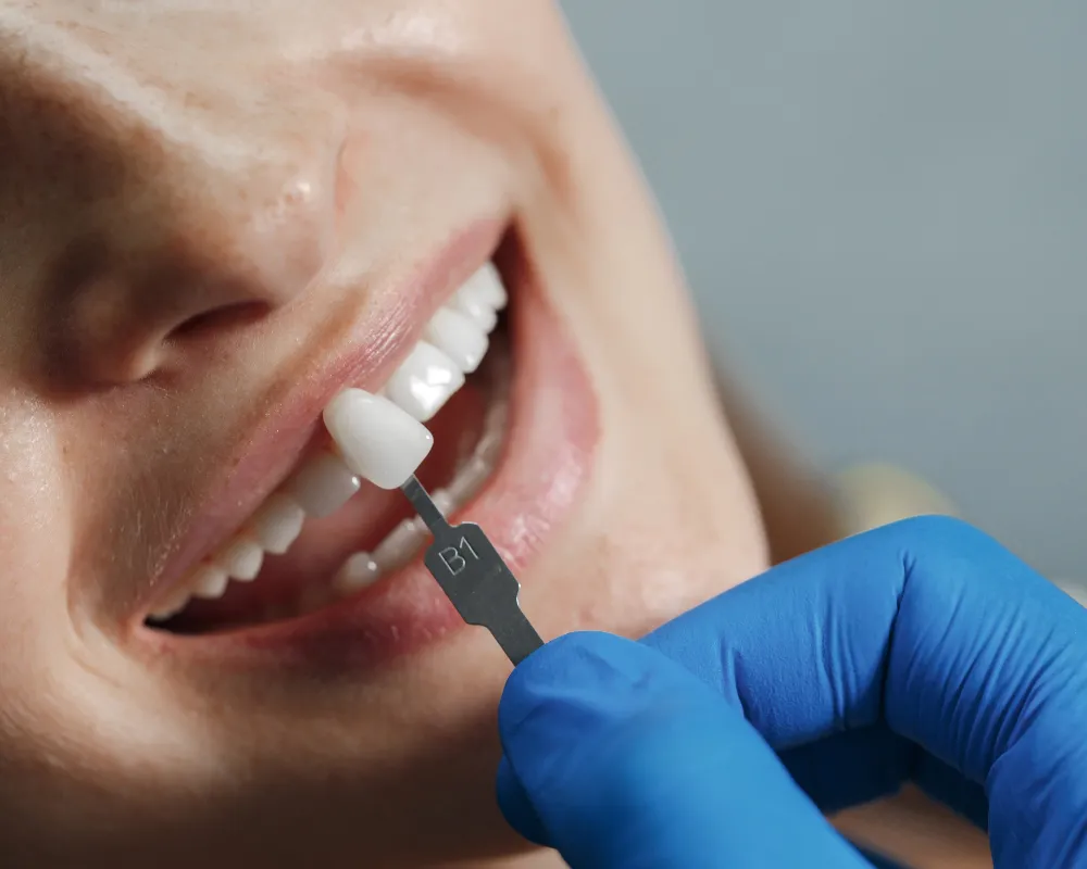 how much veneers cost