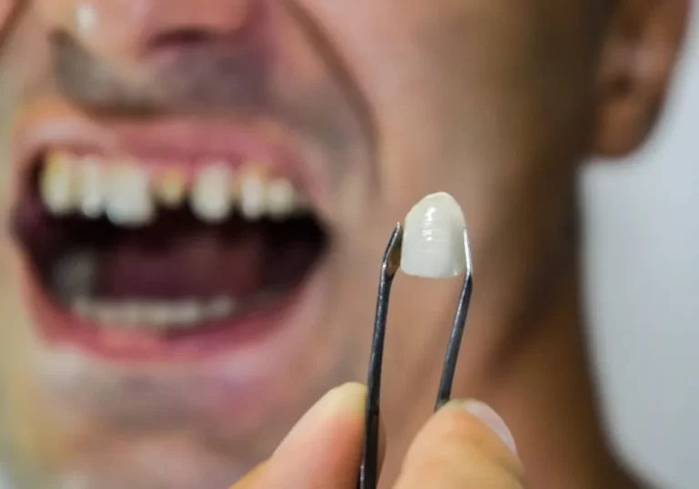 types of dental crowns
