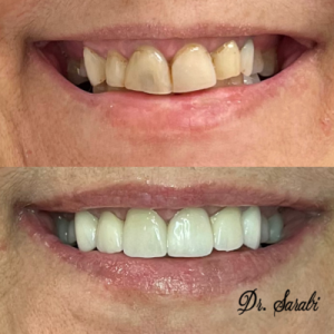 teeth before and afer 400x400 1